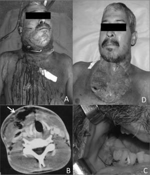 A) Extensive erythematous area associated with bilateral submandibular, submentonian, and sublingual edema extending to the neck and thorax. B) Subcutaneous emphysema of the neck - computed tomography. C) Removal of many teeth roots in the mandible (primary infection sites). D) The surgical wound on the sixth post-operative day. Note the extensive open area and residual cavity with pus.