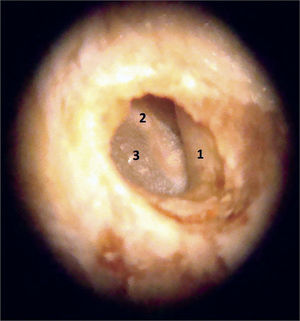 Specimen image under the microscope (10x magnification). 1: External acoustic meatus; 2: Malleus handle; 3: Tympanic membrane.