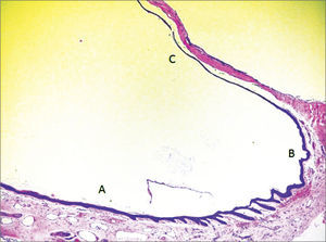 Micro-photography showing the epithelium of the lower portion of the external acoustic meatus (A), fibro-cartillagenous annulus (B) and tympanic membrane (C) (HE – 50x). Notice the presence of epithelial cones in the lower wall epidermis of the external acoustic meatus, near the fibro-cartilaginous annulus.