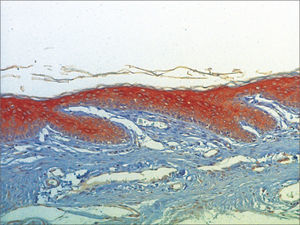 Micro-photography, showing the lower wall epidermis of the external acoustic meatus with CK16 expression (IHQ–200x).