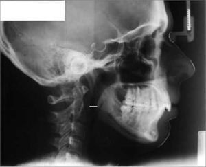 PAS (lower airway) Cephalometric value: pharynx width at the point where, radiographically, the posterior tongue border crosses the inferior mandible border, all the way to the closest point to the posterior pharyngeal wall.