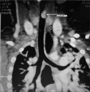 Chest and neck CT scan showing an angioma