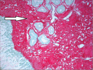 Intense subepithelial fibrosis in nasal mucosa of HTLV-1 carrier with allergic rhinitis. Sirius Red, 400X.
