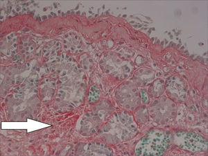 Mild subepithelial fibrosis in nasal mucosa of patient with allergic rhinitis not infected by HTLV-1. Sirius Red, 400X.