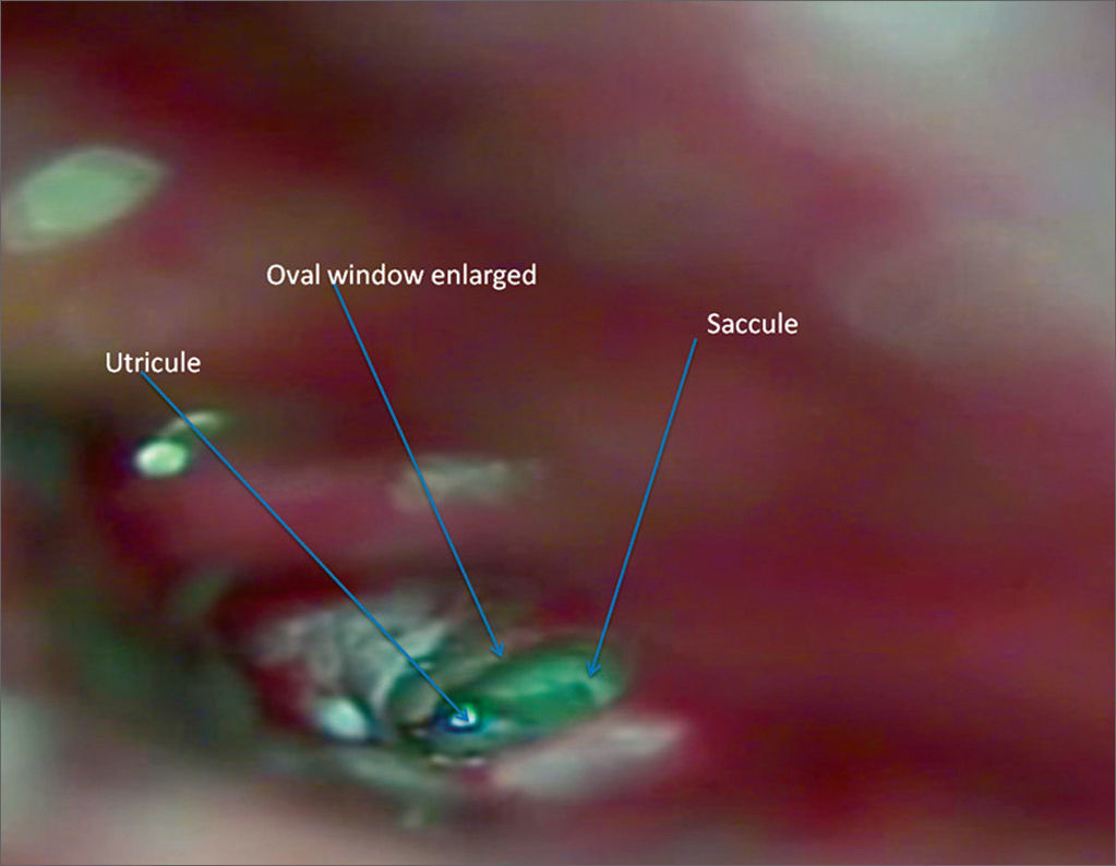 Assessing cochlear evoked potentials after electrocautery-induced ...