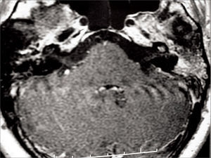 T1-weighed head MRI scan, axial view after contrast has been injected at the level of the inner ear canal; intense contrast uptake seen in the left ear's cochlea and mastoid cells.