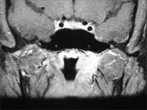 T1-weighed head MRI scan, coronal view after contrast injection; expansive injury seen on the left side wall f the rhinopharynx consistent with reactive lymphnode. The arrows indicate shifting of adjacent parapharyngeal fat.