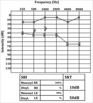 Audiometry after therapy. Left ear mild to moderate mixed hearing loss, with marked improvement on speech discrimination.