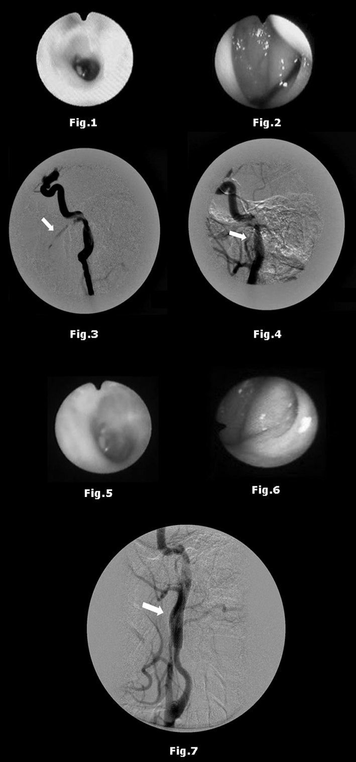 hemotympanum images
