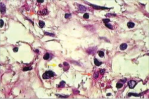 histopathology of eosinophilic nasosinusal polyp (control group) incubated for 12 hours. (H. and E. 1000x).
