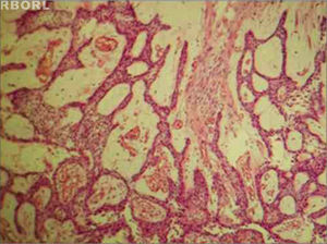 Plexiform pattern ameloblastoma, showing the cystic-type degeneration. HE 100x.