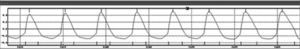 Model of an electroglottographic wave obtained through EGG/EVA recording. Electroglottographic signal Amplitude vs. Time. Source: EVA Manual.
