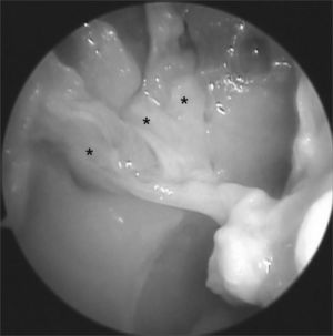 Picture of a right nasal fossa showing three arterial branches (*) emerging from the sphenopalatine foramen.