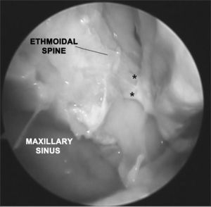 Picture of a right nasal fossa showing two arterial branches emerging from the sphenopalatine foramen. Notice the anatomic correlation between left maxillary sinus, anterior ethmoidal spine, and sphenopalatine foramen.