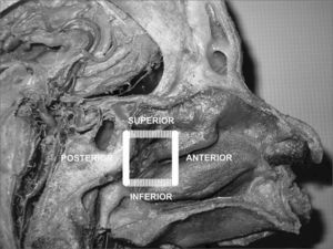 Picture of a skull sagittal view showing the left nasal fossa and the ipsilateral sphenopalatine artery. Knowledge on the limits of the “sphenopalatine quadrangle” may aid surgeons identifying all branches and foramens of the sphenopalatine artery.