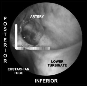 Picture of a left nasal fossa. The inferior border of the “sphenopalatine quadrangle” is the superior portion of the inferior turbinate. The Eustachian tube is the posterior border of the mucoperiosteal flap.