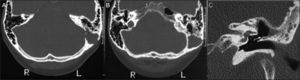 A-B: CT of the temporal bones. Axial images showed a hypoattenuating and expansive lesion in the left mastoid process eroding its medial and lateral walls, adjacent to the left sigmoid sinus. The remaining structures were unremarkable. C: Follow-up coronal CT image of the left temporal bone did not reveal recurrence and showed a large surgical cavity in the mastoid process communicating antrum with tympanic cavity.