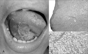 A: Clinical view of the exuberant lesion on the tongue B-C: Microphotography showing thin para-keratinized stratified squamous epithelium with numerous blood vessels (Hematoxylineosin, 200x).