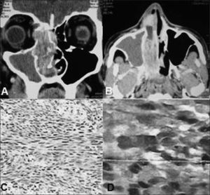 Contrast-enhanced axial (A) and coronal (B) computed tomography of the paranasal sinus, showing a voluminous mass in the right nasal cavity that extended as far as the pterygopalatine fossa, with erosion of the medial wall of the maxillary sinus, lamina papyracea and anterior and posterior ethmoid cells. Histopathological examination revealed a malignant neoplasm represented by atypical fusiform cells in fascicular arrangement, with great alternation of cellularity (HE, 40x) (C). Immunohistochemical analysis showed positivity for the S-100 protein (D).