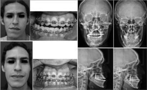 Patient pictures and X-ray images before and after surgery.
