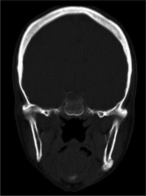 2-year postoperative: Coronal view showing a recurrence in the left mandible angle.