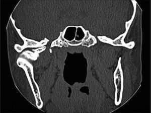 Coronal CT scan: peripheral osteoma in the right-side mandible condyle.