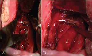 A: (without medial traction of the palatopharyngeal. Intraoperative aspect of the lateral pharyngoplasty with preservation of the stylopharyngeus muscle. 1: palatopharyngeal m.; 2: buccopharyngeal fascia; 3: stylopharyngeus m.; 4: palatoglossus m.; * crossover of the stylopharyngeus m. with the middle constrictor; (arrow) superior constrictor m; B: (with medial traction of the pharyngeal palate). Intraoperative view of the lateral pharyngoplasty, preserving the stylopharyngeus muscle. 1: palatopharyngeal m.; 2: buccopharyngeal fascia; 3: stylopharyngeus m.; 4: palatoglossus m.; * crossover of the stylopharyngeus m. with the middle constrictor; (arrow) superior constrictor m.