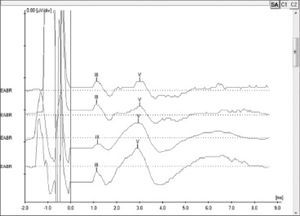 Electrically evoked brainstem responses measured during surgery for subject 5 electrodes 19, 14, 9 and 6 using Interface Navigator Pro and Software AEP version 7.0.0, Biologic. Waves III and V can be seen, showing proper nerve fiber stimulation.