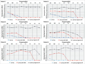 Pre and postoperative audiometric thresholds of six cochlear device implantation patients using Digisonic® SP. Note threshold improvement.
