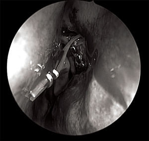 Notice the silicone tubes fxed with Ligaclip inside the nasal cavity.
