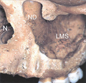 Anterolateral view of the medium portion of the face in a bony anatomical specimen. ND: impression of the nasolacrimal duct on the middle wall of the left maxillary sinus; LMS: Left Maxillary Sinus; N: Nasal pyriform opening.