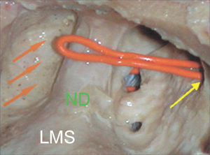 Lateral view of the dissection of the left maxillary sinus of the ANT (anterior) type. Orange arrow: lacrimal recess; Yellow arrow: main ostium of the maxillary sinus; ND: Nasolacrimal Duct; LMS: Left Maxillary Sinus.