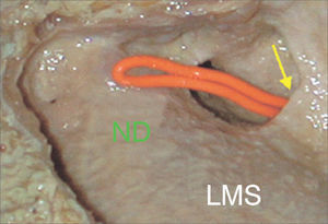 Lateral view of a dissection of the left maxillary sinus LAT (lateral) type. Yellow arrow: main ostium of the maxillary sinus; ND: Nasolacrimal Duct; LMS: Left Maxillary Sinus.