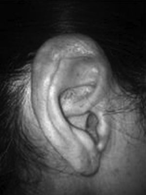 Amyloidosis lesion on the ear pinna.