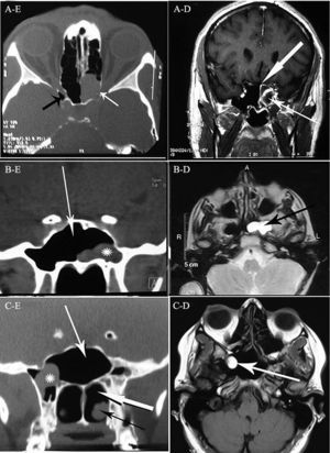 A: (Left) axial CT scan of sinuses shows complete opa-cification of the left sphenoid sinus with dehiscence in the left optic canal (white arrow), opticocarotid recess (black arrow); (Right) MRI shows the cyst with rim enhancement obstructing the sinus ostium (thin arrow), thick arrow shows enhanced sphenoid sinus mucosa. B: (Left) coronal CT scan of sinuses shows a retention cyst (astrix) in the lateral recess of sphenoid sinus, white arrow shows sphenoid sinus; (Right) T2-weighted MRI shows left sphenoid sinus hyper-intense retention cyst (black arrow). C: (Left) coronal CT scan shows sphenoid sinus (white thin arrow) and retention cyst (astrix) without pressured on the optic chiasm, posterior chornea (thick white arrow) and inferior turbinate (black arrow); (Right) MRI shows hyper-intense mass in the sphenoid sinus and its lateral recess (white arrow).