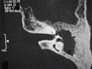 Left-side temporal bone CT scan, axial cross-section, showing blurred antrum and erosion of the lateral semicircular canal.