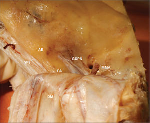 Anatomy of the middle cranial fossa viewed perpendicularly from the petrous. AE: Arcuate eminence; SPS: Superior petrosal sinus; GSPN: Greater superficial petrosal nerve; PA: Petrous apex. DM: Dura mater of the middle cranial fossa; MMA: Middle meningeal artery.