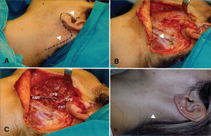 Superficial parotidectomy via modified rhytidectomy. A: Drawing of the pre-auricular incision extending to the hairline (arrows). B: Dissection of the fasciocutaneous fap; exposure of the parotid and anterior border of the sternocleidomastoid muscle (arrow). C: Surgical field view after resection of the parotid's superficial portion (FNT: Facial nerve trunk; CFB: Cervicofacial branch; TFB: Temporofacial branch; RMV - Retromandibular vein). D: Late scar hidden in the hairline (arrow).
