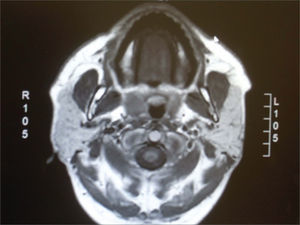 Axial section in T1 without contrast, showing hypersignal from the parotids.