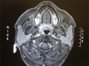 Axial section in T1 with contrast and fat suppression, showing hyposignal in the areas in which fat was suppressed.