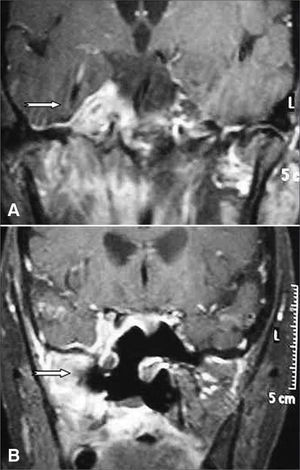 A: Preoperative skull MRI (contrast-enhanced T1). The arrow points to an expansive mass in the right cavernous sinus; B: Postoperative skull MRI (contrast-enhanced T1). The arrow points to the right cavernous sinus now without the mass.