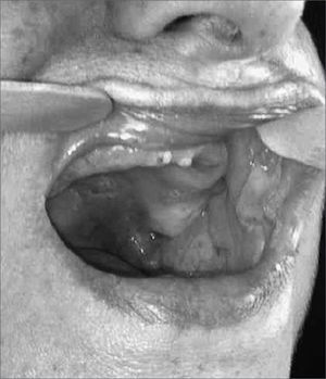 Oroscopy - Bullous and ulcerated lesions on the cheek mucosa and palate.