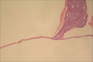 Appearence of normal tympanic membrane (0 point scale) in group A (hematoxylin and eosin, original magnification x100).