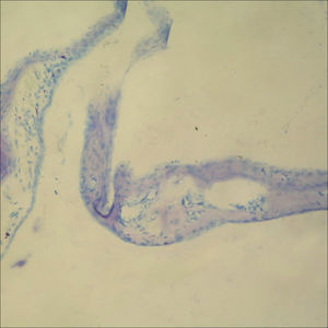 In tympanic membrane evaluated as 4 point scale from group B, the fibroblast proliferation, markedly increased of membrane thickness, sclerotic changes are shown (toluidine blue, original magnification x200).