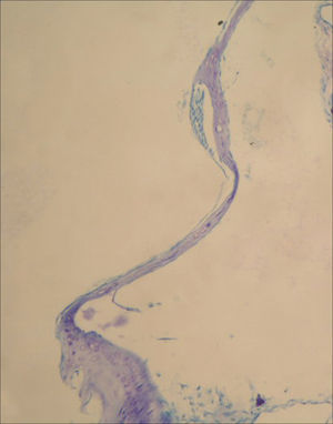 In tympanic membrane evaluated as 2 point scale from group C, moderately thickened and sclerotic plaque are shown (toluidine blue, original magnification x200).