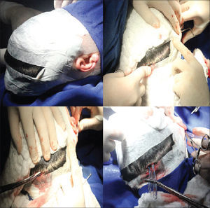 Sequence of pictures showing patient preparation and placement of 5 mm orotracheal tubes to aid electrode insertion.