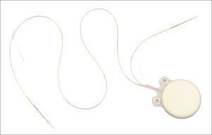 Digisonic SP® Binaural cochlear implant. Receiver-stimulator and ipsilateral and contralateral electrode beams.