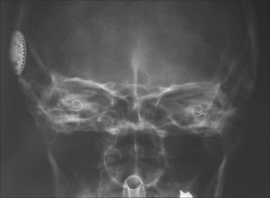 Transorbital x-ray image of the patient at the end of the procedure showing both electrodes inserted in the cochleas.