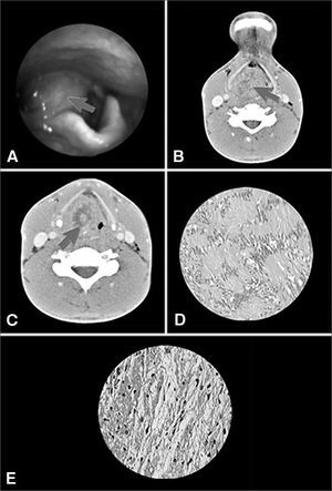 A: Tumor in the right aryepiglottic fold obliterating the ipsilateral piriformis sinus (arrow); B: Heterogeneous image obliterating the pharyngeal lumen (CT scan of the supraglottis - axial view - arrow); C: Tumor obstructing the glottis and preventing the proper identification of the vocal folds (CT scan of the glottis - axial view - arrow); D: Presence of Antoni A areas in histology examination (400x magnification); E: Presence of Antoni B areas in histology examination (400x magnification).