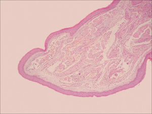 Histology of Vocal Cord Polyp. Overview of the vocal fold polyp histology stained with hematoxylin and eosin (HE 20x). Notice the intact epithelium and the thin basement membrane. In the lamina propria there are vascular changes, amorphous material deposits, past hemorrhage and hemosiderin.